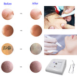 Skin Tag Skin Mole Removal /Dark Spots Removal Machine
